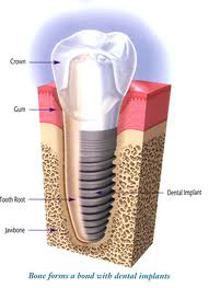 Cosmetic Dental Implant Restoration
