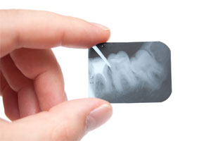 Digital Dental X-Ray