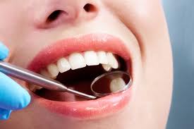 Dental Fillings