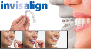 Invisalign